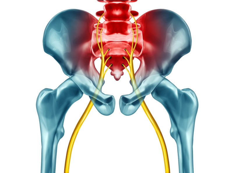 sciatica image